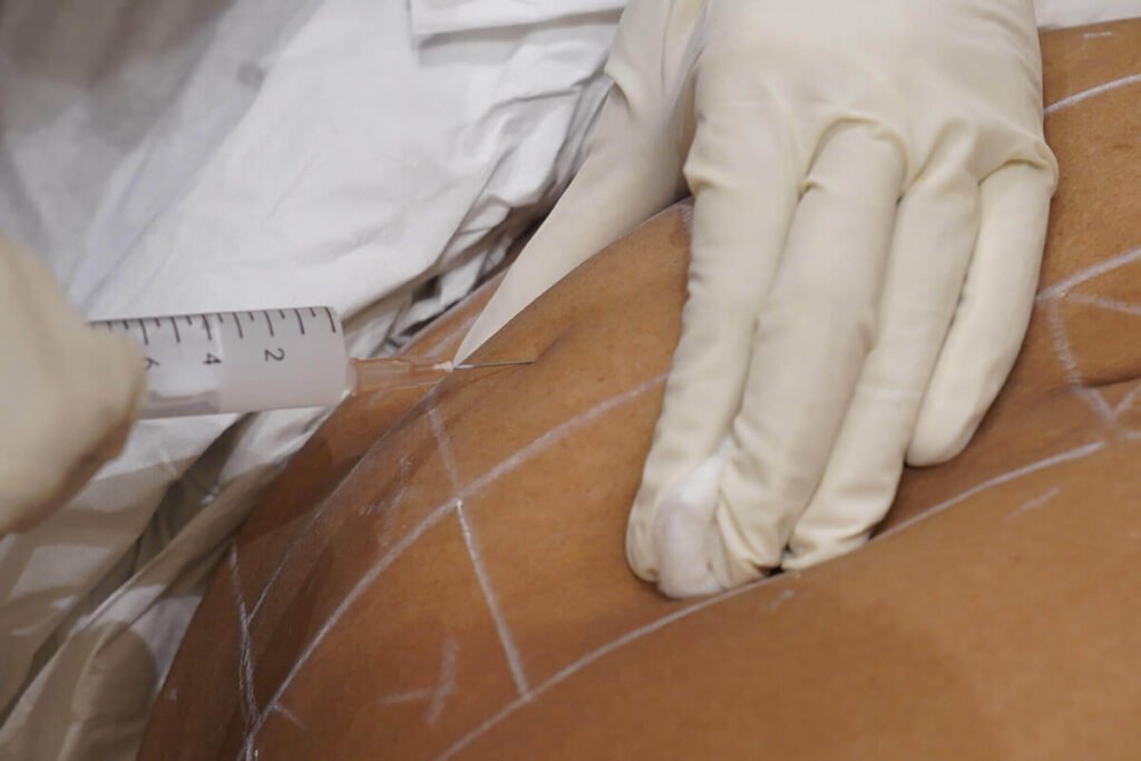 Aqualyx Fat Dissolving Injections