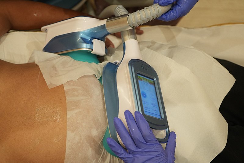 CoolSculpting services