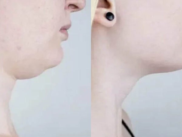 Double-Chin-Reduction-1