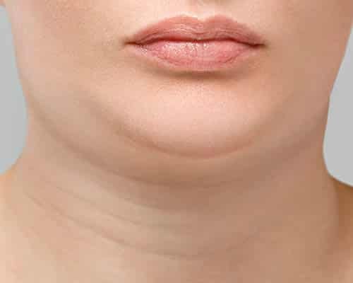 Double Chin Reduction