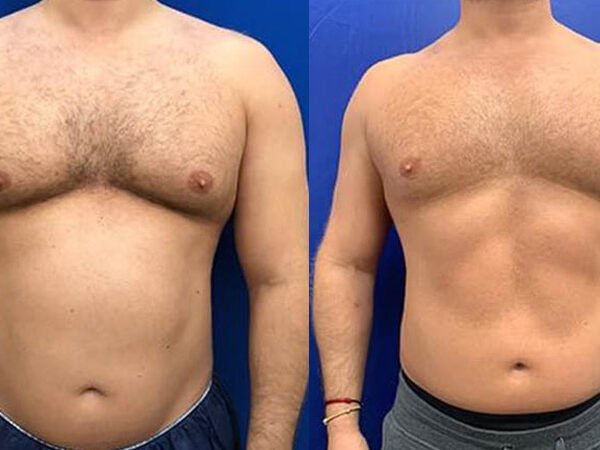 EMSCULPT-Before-After-1