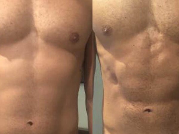 EMSCULPT-Before-After-2