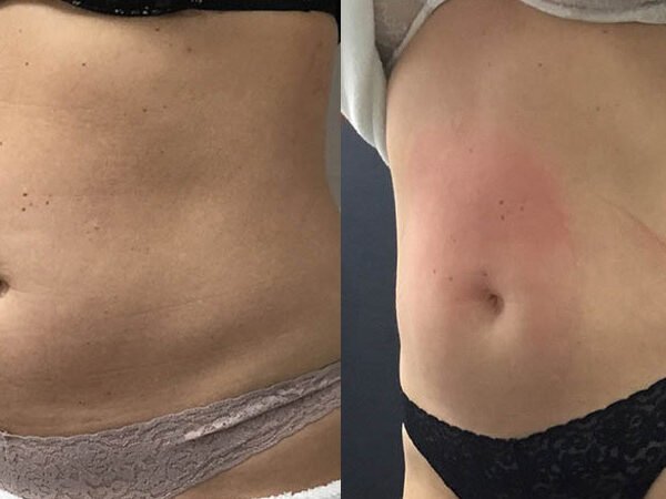 EMSCULPT-Before-After-4