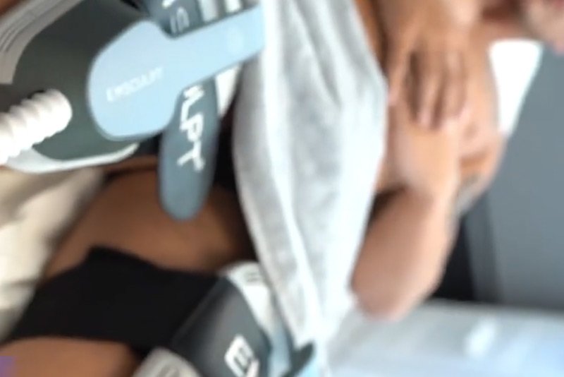 EMSculpt treatment