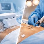 Fat Freezing or Liposuction