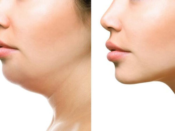 Lemon-Bottle-Before-After-1