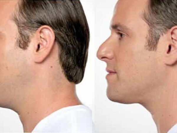 Lemon-Bottle-Before-After-5