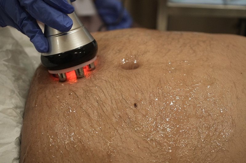 Radio Frequency Body Tightening