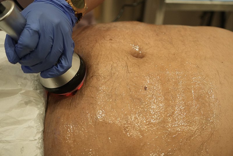 Radio Frequency Fat Melting