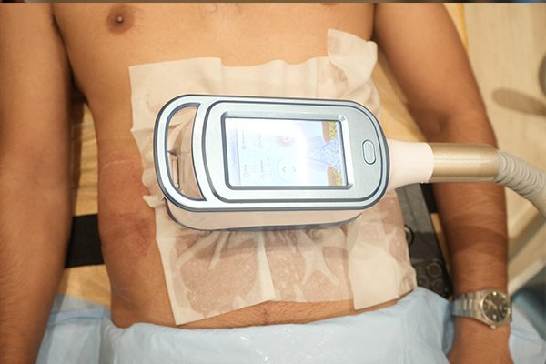 Fat Freezing (Cryolipolysis) in the UK