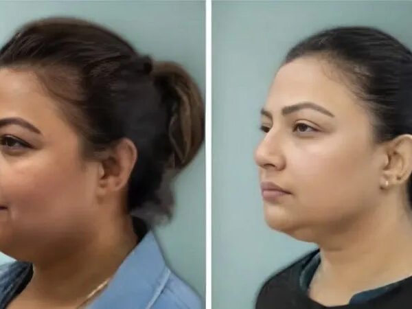 Fat-freezing-near-me-before-after-10