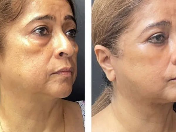 Fat-freezing-near-me-before-after-11